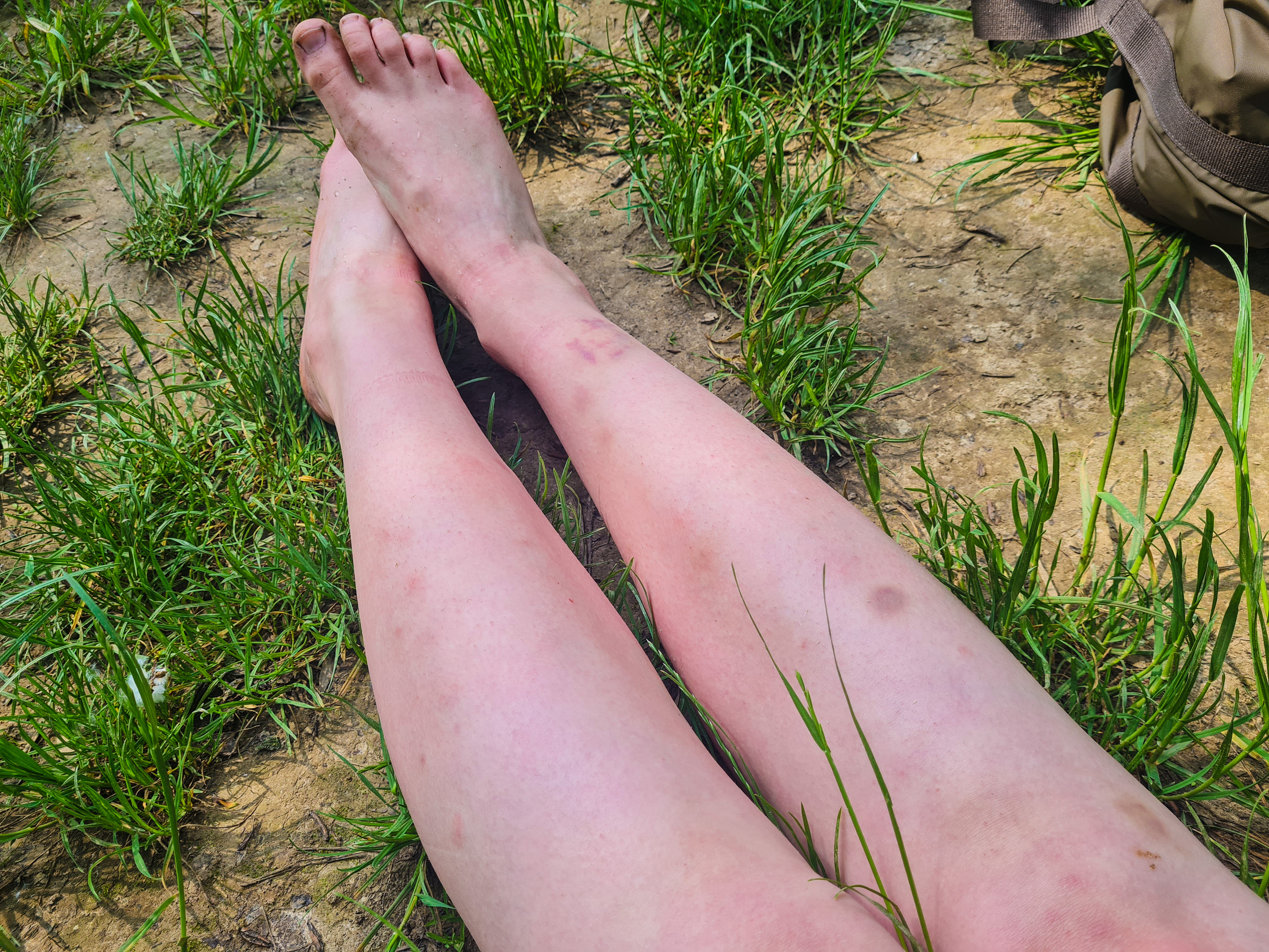 Mückenstiche Wald Baumhaus Besetzung